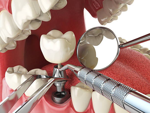 Best Emergency Root Canal Treatment in Columbus, WI